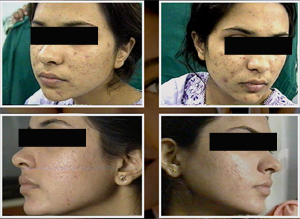 acne_scarring2