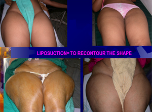 liposuction1