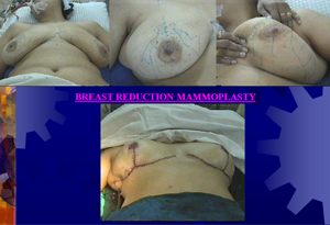mammoplasty1