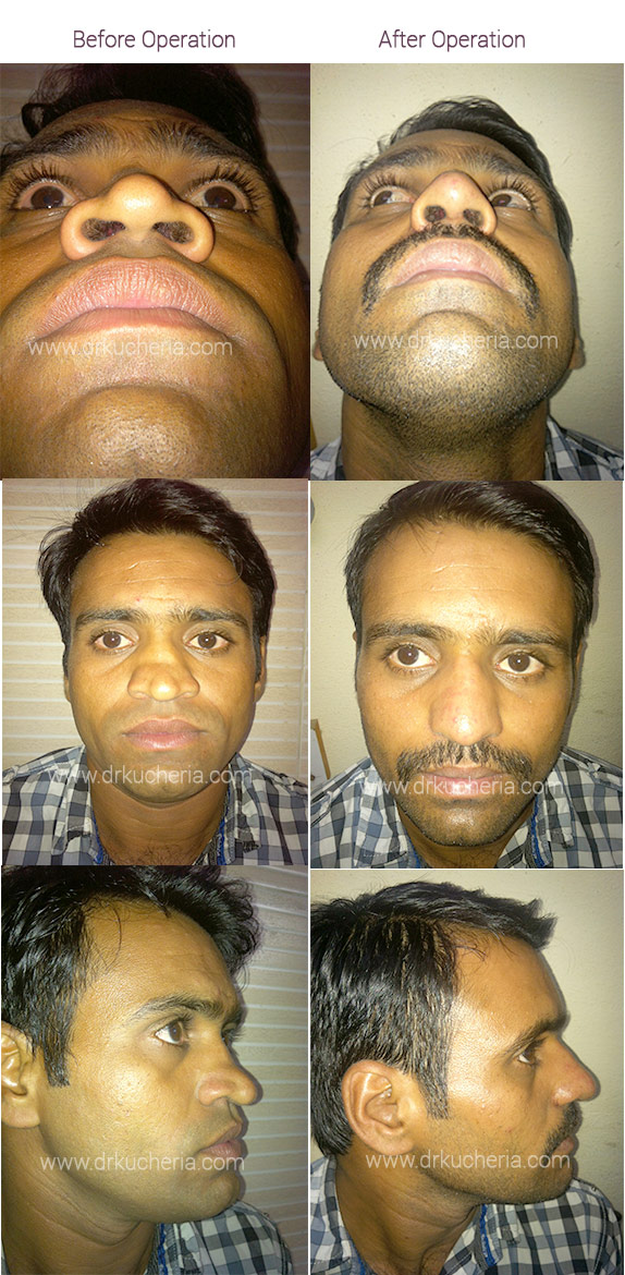 Nose-Correction-Surgery-(Rhinoplasty)-at-Sushrut-Plastic-Surgery-Centre,-Indore